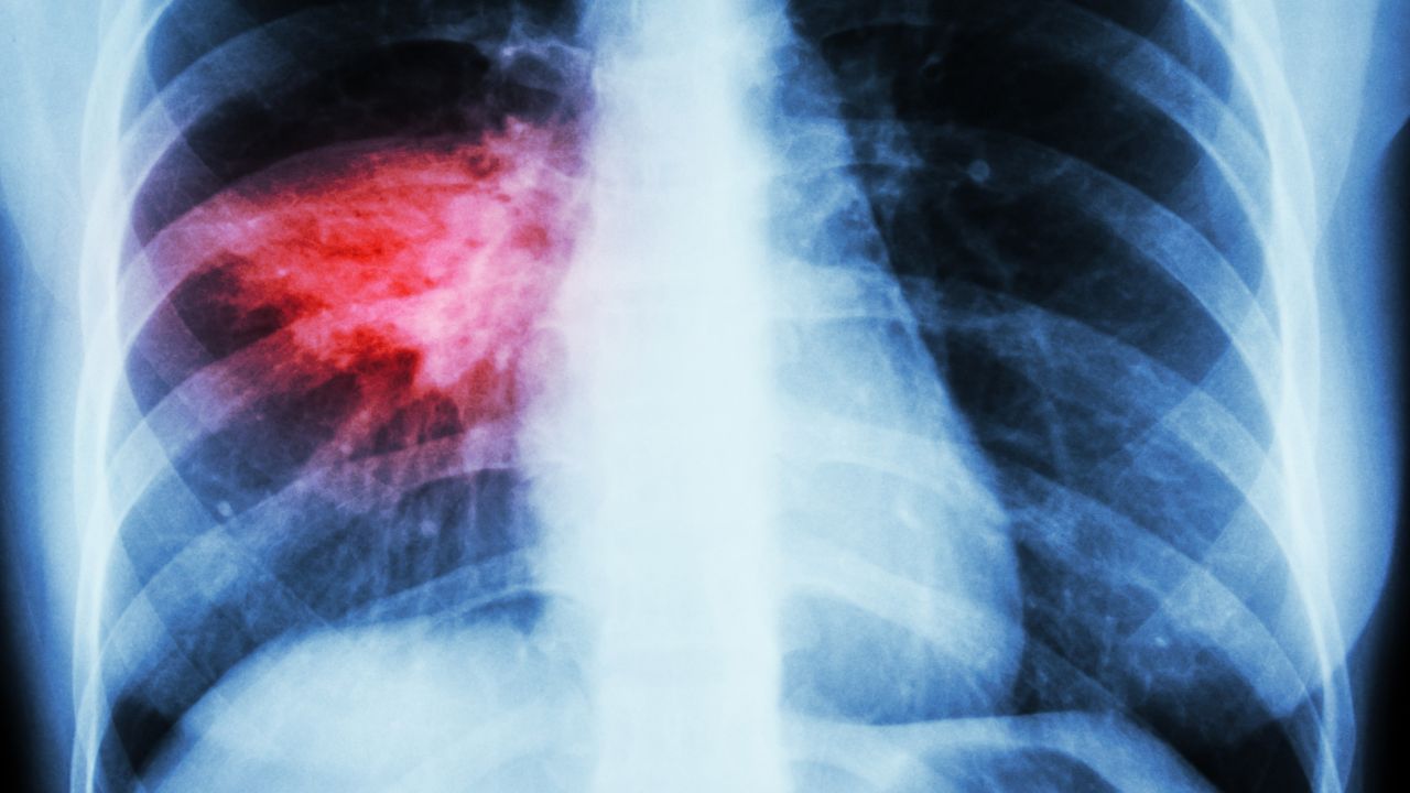 Macrolides for community-acquired pneumonia: to add or not to add?