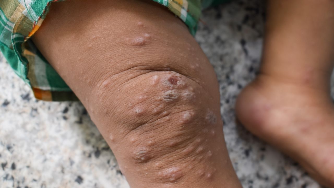 How to treat mpox infections?